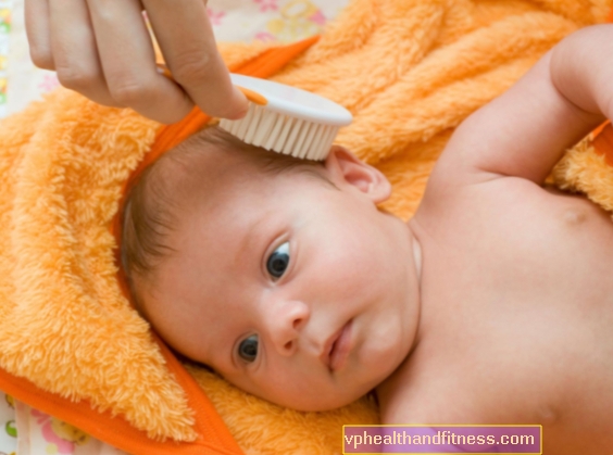 SOMBRAS: ¿cómo combatir las escamas amarillas en la cabeza del bebé?