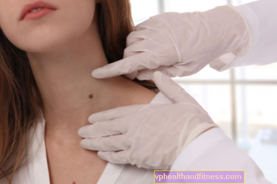 Cicatriz hipertrófica en el cuello: ¿cómo tratar? 